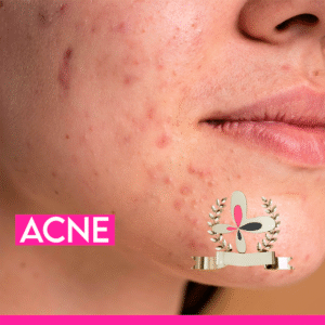 Curso de Tratamento de Acne