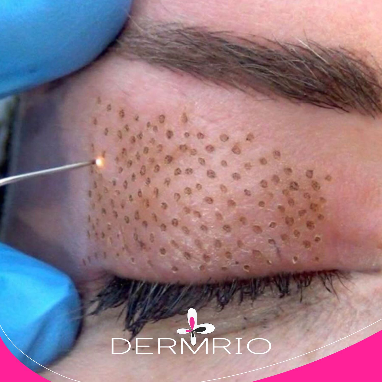 Bléfaro sem cortes – DERMRIO
