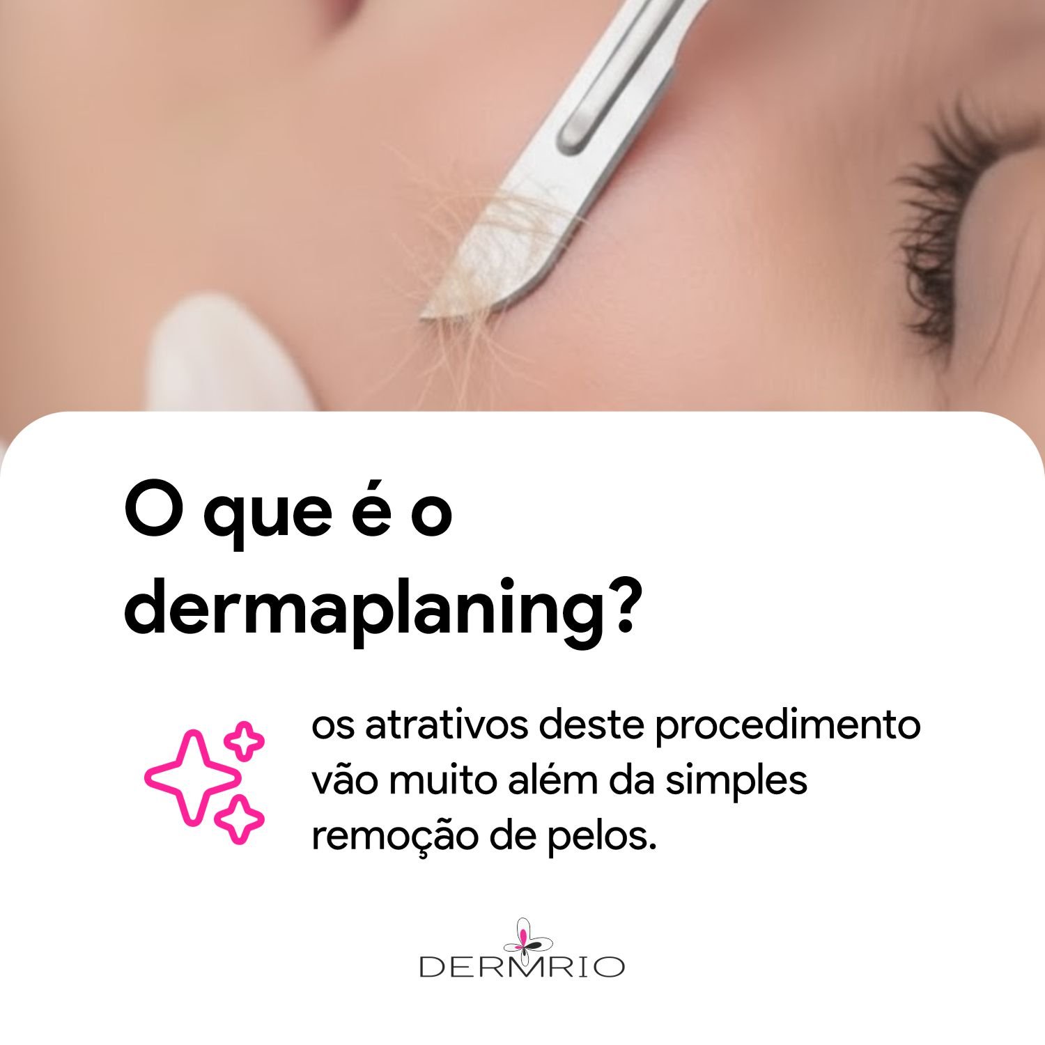 O que é dermaplaning - Dermrio (1:1)