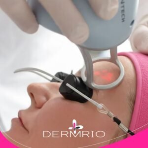 Imagem de aplicação do Laser Lavieen