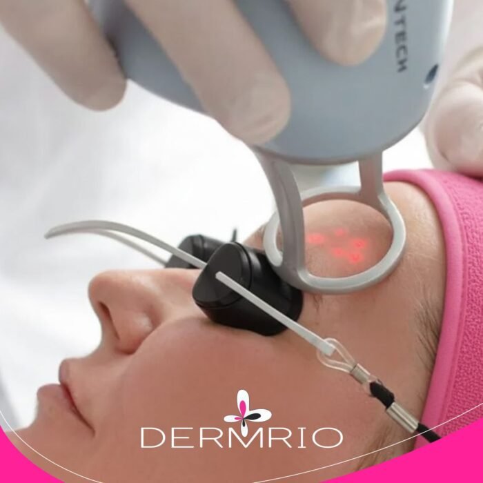 Imagem de aplicação do Laser Lavieen