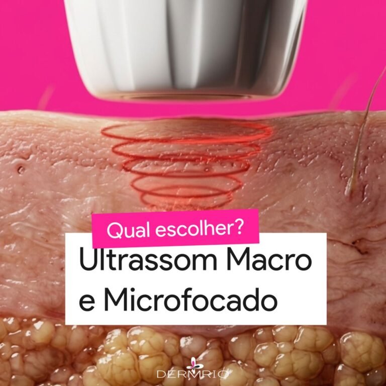 Como escolher entre Ultraformer e ultrassom microfocado