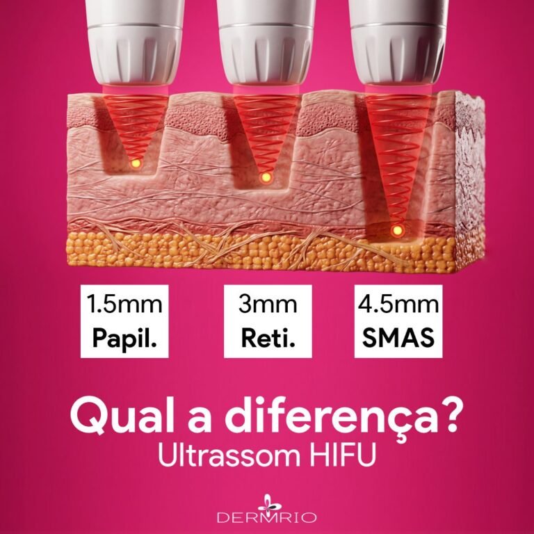 Qual a diferença entre Ultraformer e HIFU
